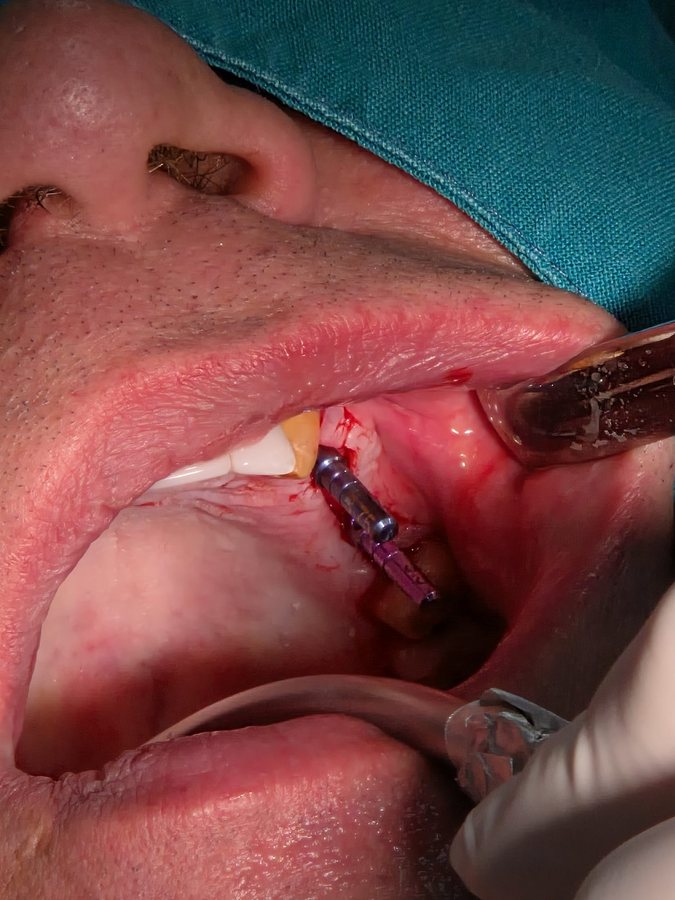 Ugradnja implantata