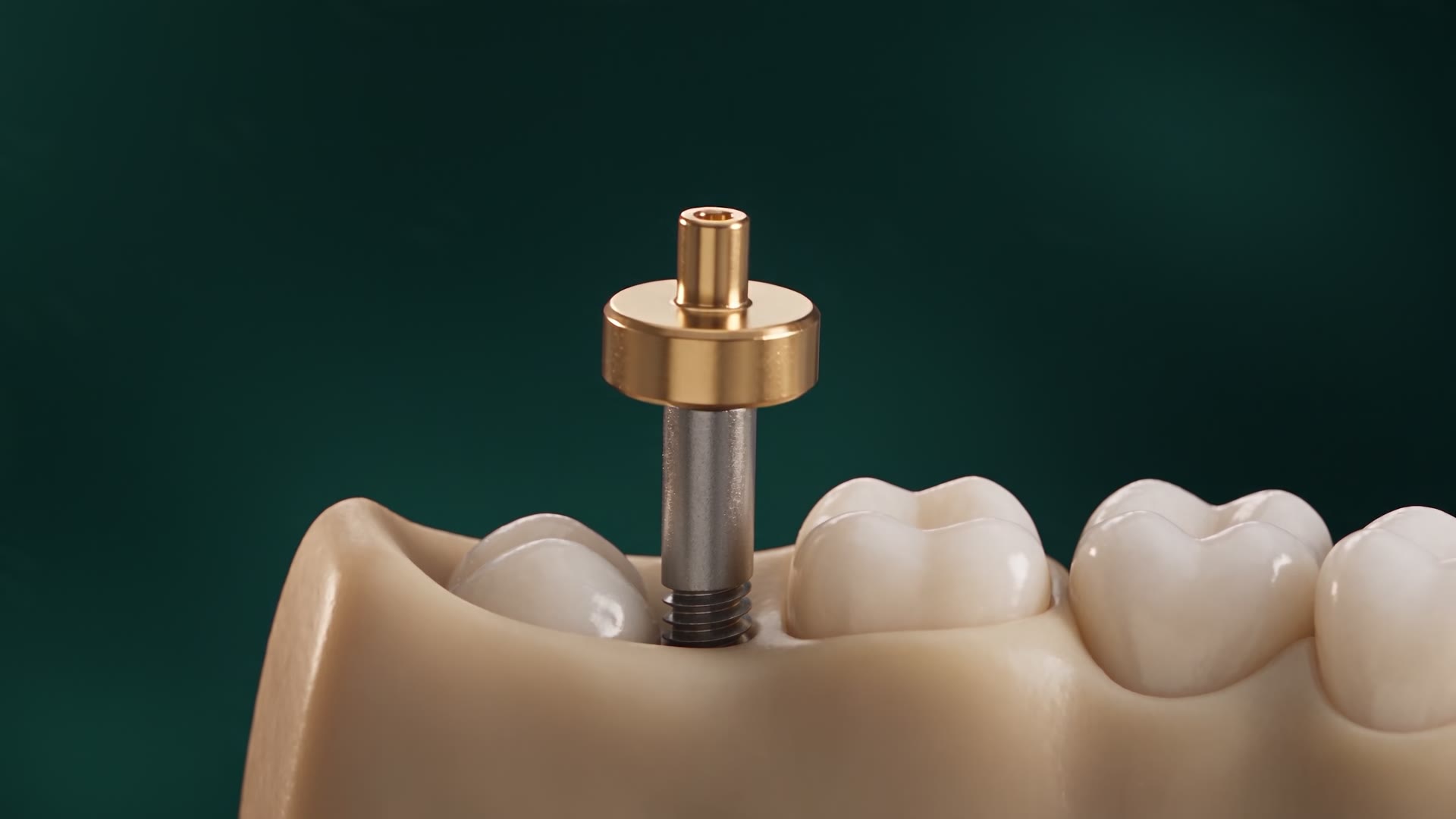 Titanijumski implant