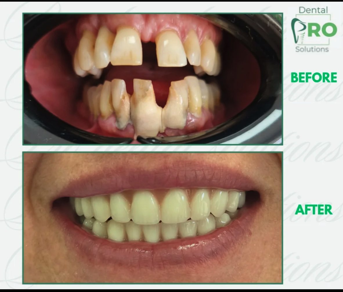 Kompletna transformacija osmeha — Pro Dental Solutions