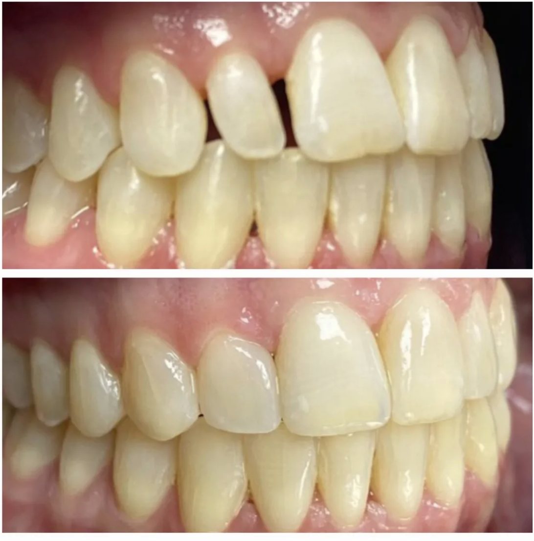 Estetska korekcija oblika i veličine zuba — Pro Dental Solutions