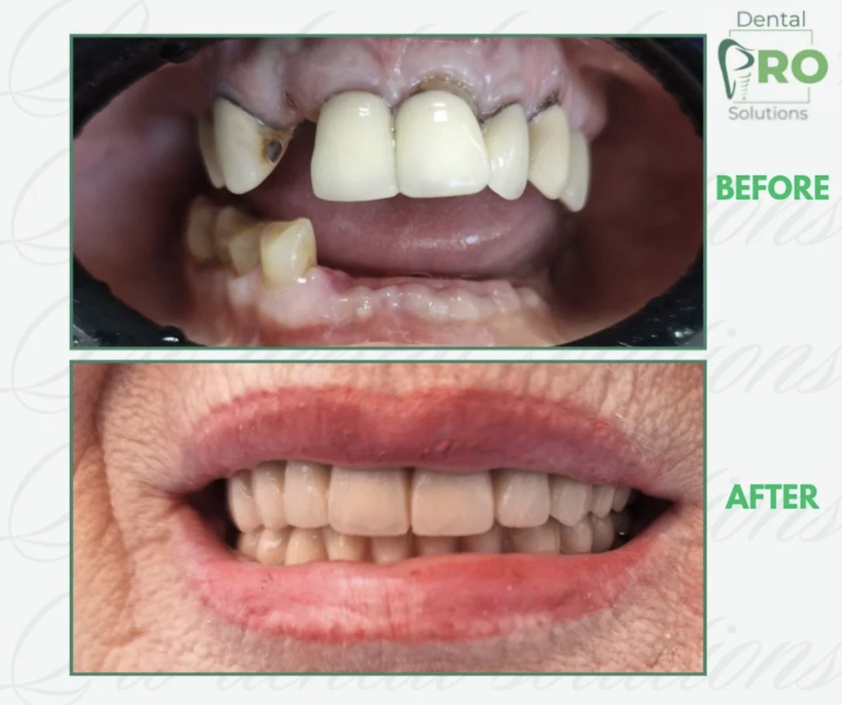Kombinovani protetski rad — Pro Dental Solutions