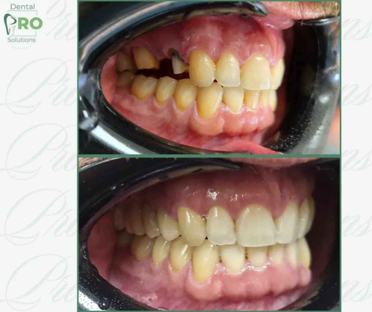 Cirkonijumski most — novi slučaj — Pro Dental Solutions