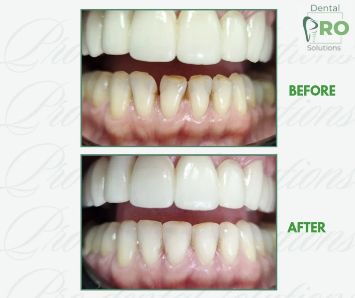 Fasete + beljenje — Pro Dental Solutions